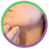 Acné, psoriasis, boutons, eczéma Acné, psoriasis, boutons, eczéma
